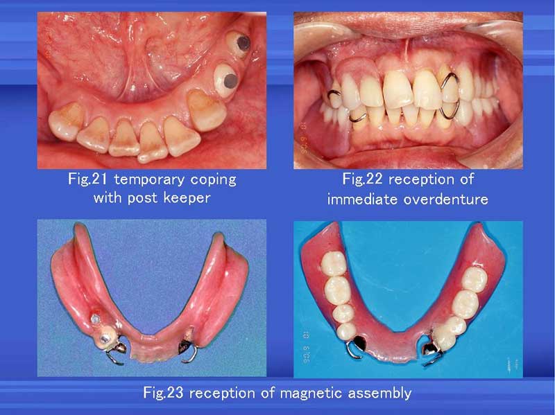 Overdenture Pictures