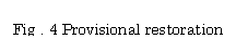 eLXg {bNX: Fig . 4 Provisional restoration