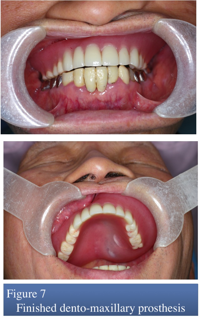 Maxillary Tumor